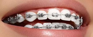 braces treatment in begusarai